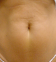 Patient 6 months after Thernage abdomen treatment by Dale Isaacson, M.D.