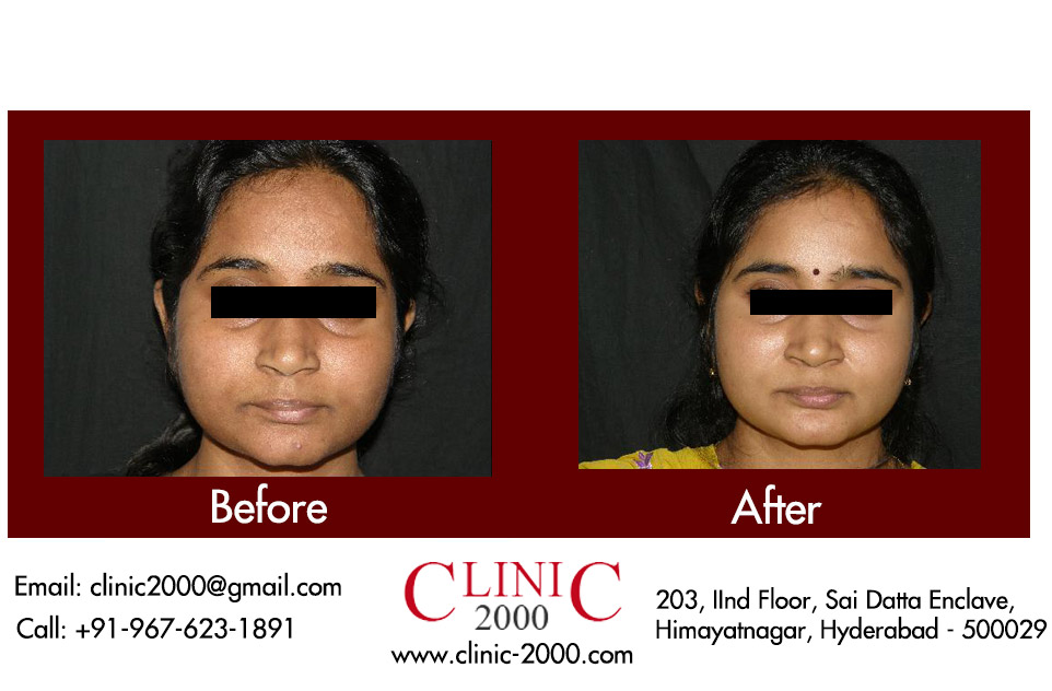 Pimple Marks Treatment