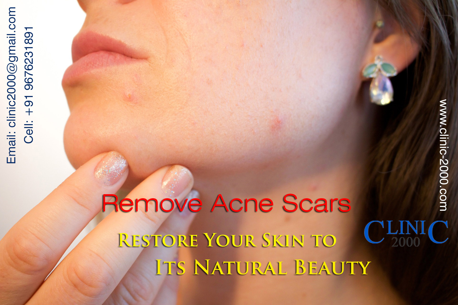Acne Scar Treatment in Hyderabad