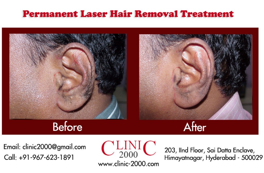 Laser Hair Removal for the Ears - Clinic 2000