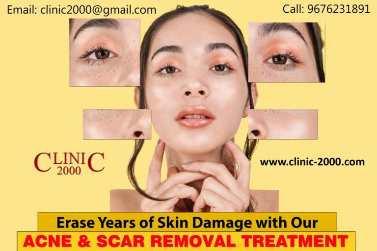 Best Acne Treatment Clinic in Hyderabad Clinic 2000