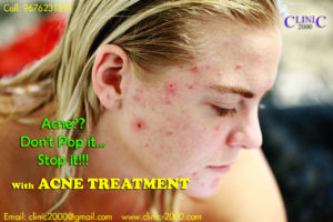 Best Acne Treatment Clinic in Hyderabad