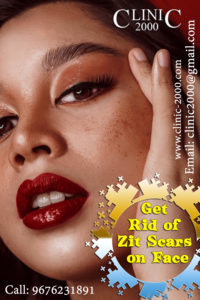 Get Rid of Zit Scars on Face
