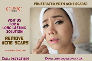 Frustated with Acne Scars Visit Clinic2000 For a Long Lasting Solution Remove Acne scars
