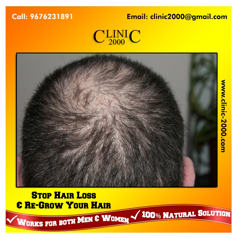 How to stop hair fall and help to regrow it-Stop Hair Loss and Re-Grow Your Hair