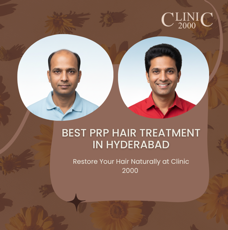 Best PRP Hair Treatment in Hyderabad | Natural Hair Regrowth at Clinic 2000