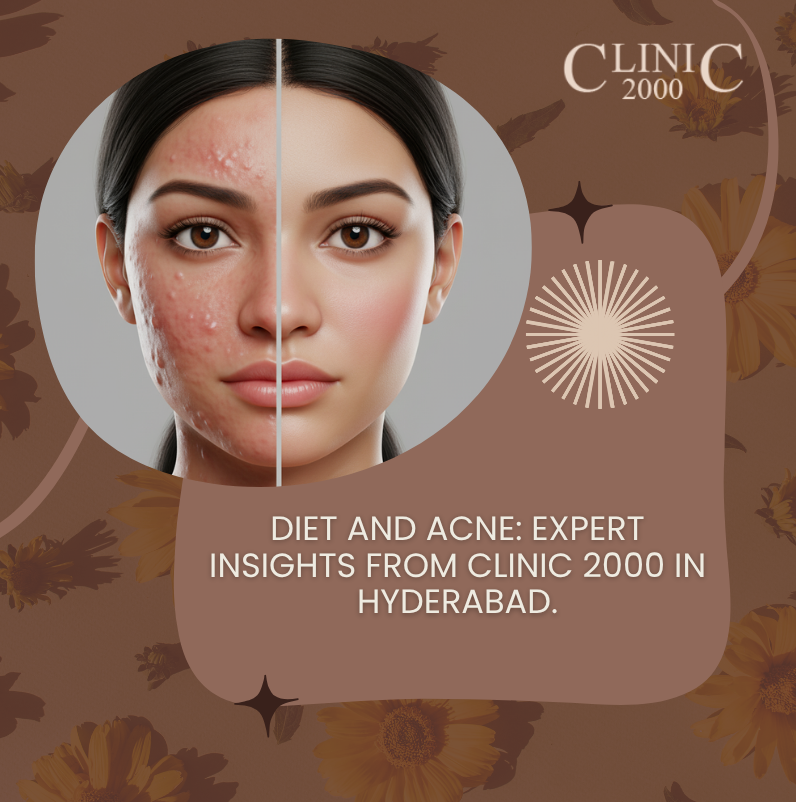 The Role of Diet in Acne: Myths and Facts Explained by Clinic 2000, Hyderabad