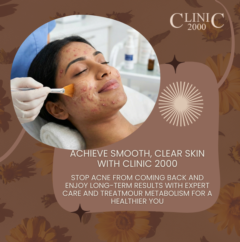Why Your Acne Keeps Coming Back – And How Clinic 2000, Hyderabad Can Help You Finally Stop It