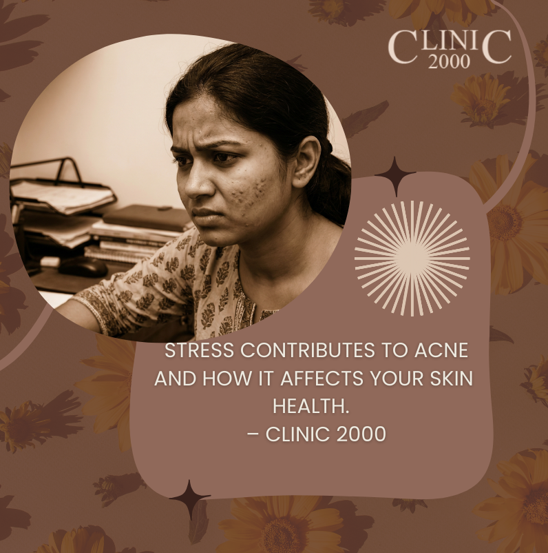 Stress and Acne: The Connection & Solutions for Clear Skin | Clinic 2000