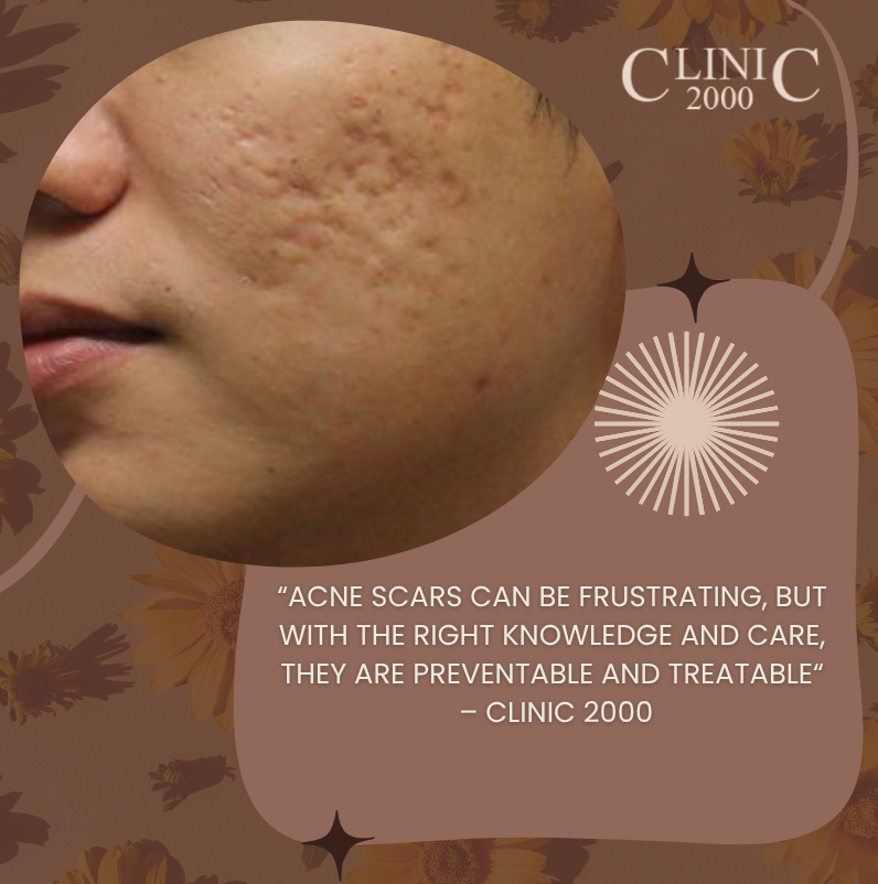 The Truth About Acne Scarring: Why It Happens and How to Prevent It | Clinic 2000