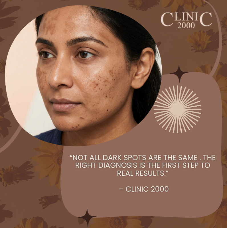 Melasma vs. Pigmentation: What’s the Difference & How to Treat It