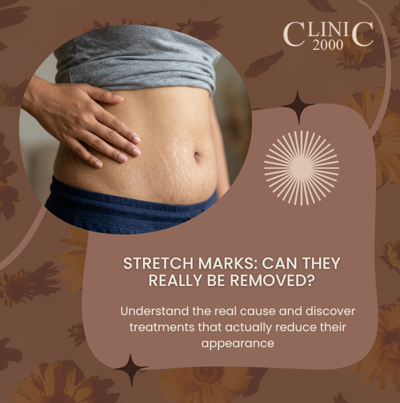 Stretch Marks: Can They Really Be Removed?